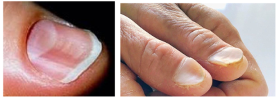 Ложкообразные ногти (койлонихии) — следствие нехватки железа