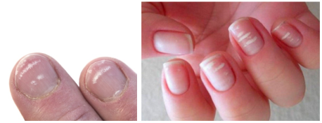 Лейконихии — вследствие травм в области ногтевой фаланги, различных инфекций и интоксикаций