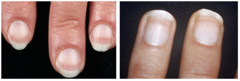 Ногти Терри (ногти с тёмной полоской на кончике) — признак сердечной патологии