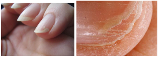 Расслоение ногтей — вследствие нарушения обмена веществ, неправильное снятие гель-лака, грибковых заболеваний