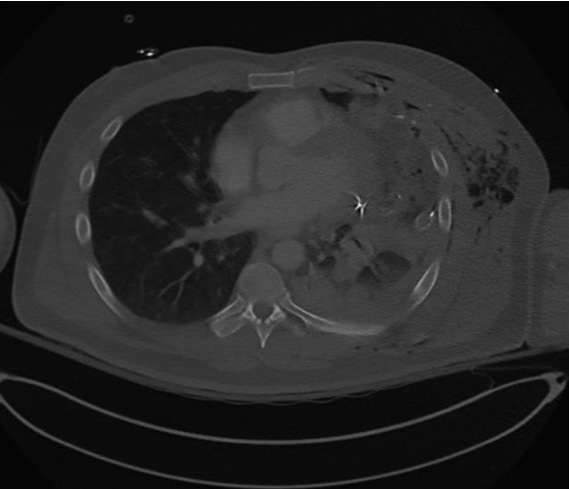 Изображение компьютерной томографии грудной клетки, показывающее фрагмент пули, прилегающий к перикарду и грудной клетке трубка, дренирующая большой левый гемоторакс