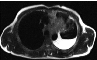Магнитно-резонансная томография (T2W) пациента