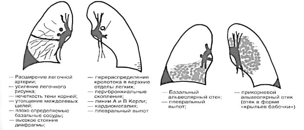 Легочный рисунок