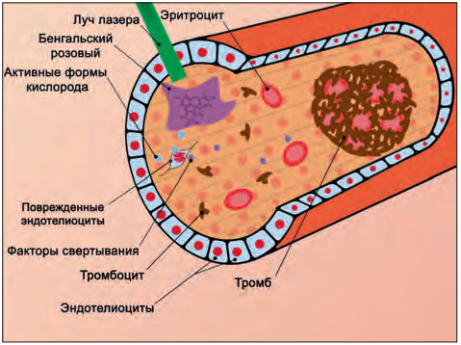Схематическое изображение механизма развития окклюзии кровеносного сосуда при фотоиндуцированном тромбозе