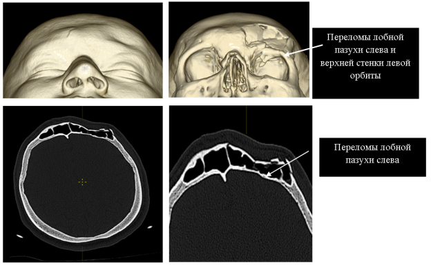 Визуализация повреждений при КТ-исследовании головы. Определяется вдавленный перелом лобной пазухи слева, перелом верхней стенки левой орбиты
