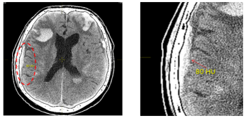 КТ-изображение головного мозга человека. Аксиальная плоскость. Визуализируется гематома 80 H. (обозначена пунктиром и стрелкой)