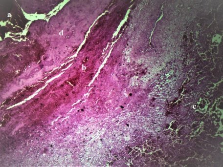 Микроскопическая картина стенки хронической ложной аневризмы в ткани легкого. Г+Э. СМх40
