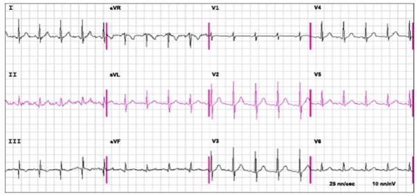 An ECG in Pulmonary Embolism