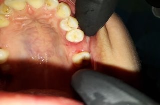 Перфорация верхнечелюстной пазухи при удалении зуба, причины и лечение