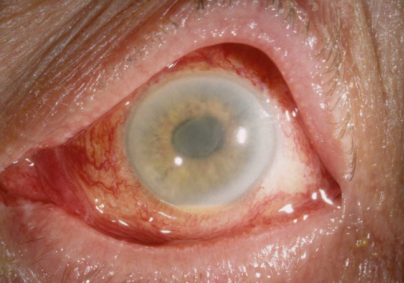 Токсический синдром переднего сегмента глаза thumbnail