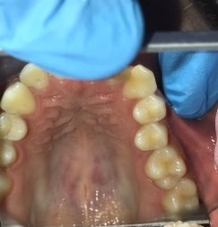 а) клинически не выявленный кариес зубов 25–26; б) скрытый кариес зубов 25–26 на снимке Bitewing