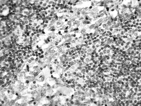 Экспрессия α -1-антихимотрипсина в ретикулярных клетках при синусном гистиоцитозе. LSAB-метод с докраской гематоксилином. х 200.