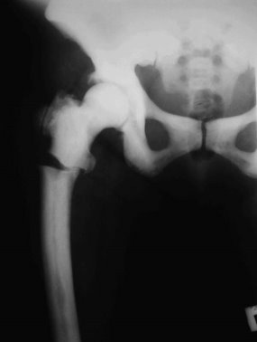 Перелом правой бедренной кости при мраморной болезни