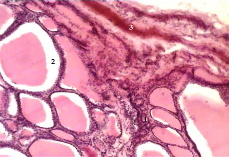 Лимфоклеточная инфильтрация вокруг межфолликуллярного капилляра (1), резорбция коллоида в фолликулах (2), неравномерный просвет порядковой артерии капсулы щитовидной железы (3) при диффузно-токсическом зобе. Мужчина, 45 лет. Микропрепарат. Окраска гематоксилин-эозином. Ув. 200