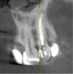 Латеральное отклонение апекса в зубе 2.2