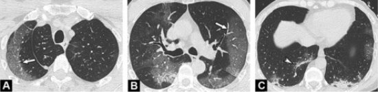 КТ-изображения показывают типичные признаки пневмонии COVID-19 у 55-летнего мужчины. Периферические участки «матового стекла» видны в верхней части обоих легких (A, B) (стрелки), связанные с линейными уплотнениями в нижних долях (C) (наконечник стрелки)