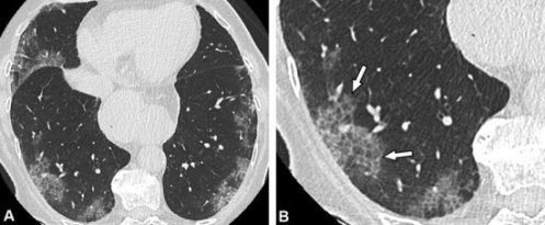 КТ-изображения 86-летней женщины с «булыжной мостовой» при пневмонии COVID-19 без улучшения. (а) КТ-исследование, проведенное через 4 дня после появления симптомов (сухой кашель и боль в груди), демонстрирует умеренную степень заболевания (10–25 %). (b) Периферические затемнения из матового стекла с наложенными внутрилобулярными сетками (стрелки), приводящие к сумасшедшему рисунку мощения, видны в обеих нижних долях