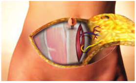 Внешний вид DIEP-лоскута на этапе выделения перфорантов глубокой нижней эпигастральной артерии и сенсорной ветви межреберного нерва