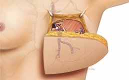 Анастомоз внутренних грудных артерии и вен с перфорантами от глубокой нижней эпигастральной артерии и вен. Анастомоз передней кожной ветви 3-го межреберного нерва с сенсорной ветвью DIEP-лоскута