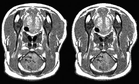 МРТ-изображения, демонстрирующие развитие отека головного мозга после острой гипонатриемии (слева, до снижения концентрации Na в плазме; справа — через 7 ч гипонатриемии). Мозг прижат к основанию черепа (А), сжаты желудочки (В), и сагиттальный синус (С)