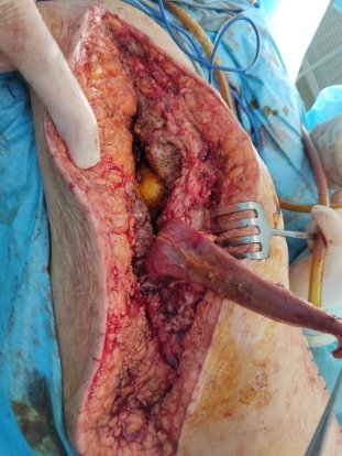 Выведение мышечного лоскута на область дефекта