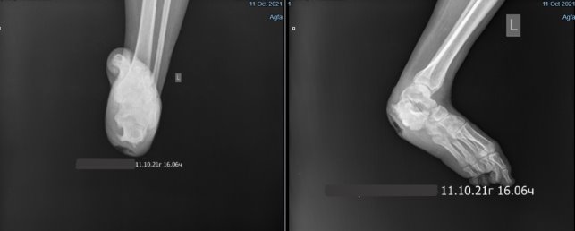Рентгенограммы левой стопы