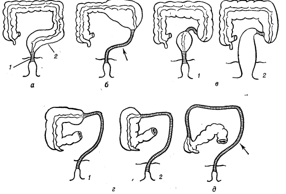 Рис. 1. Схемы основных анатомических форм болезни Гиршспрунга: а — ректальная (1 — участок аганглионарной зоны прямой кишки, 2 — расширенная сигмовидная кишка); б — ректосигмоидальная (стрелкой указан участок аганглионарной зоны прямой и сигмовидной кишки); в — сегментарная (1 — с двумя сегментами и участком нормальной кишки между ними, 2 — с одним сегментом); г — субтотальная (1 — с поражением прямой, сигмовидной и поперечной ободочной кишок, 2 — с распространением на правую половину толстой кишки); д — тотальная (стрелкой указана аганглионарная зона всей толстой кишки).