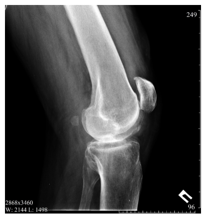 Фабелла на боковой рентгенограмме коленного сустава
