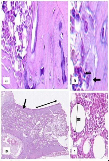 Структурные изменения в бедренной кости через 8 недель моделирования остеопороза (группа 3): а — трабекулы с очагами хондроидной дегенерации и пластинчатого расслоения, б — лимфо-гистиоцитарный инфильтрат (верхняя стрелка) и типичный активный остеокласт с резорбционной лакуной (нижняя стрелка), в — выраженное гиперпластическое ожирение в шейке (широкая стрелка) и области метафиза (двуконечная стрелка), крупные жировые клетки (диаметр помеченной измерительным отрезком 57,5 мкм). Окр. гематоксилином и эозином. Сканированные препараты