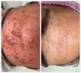 А. Пациент Дмитрий экспериментальной группы с диагнозом акне (acne vulgaris) папуло-пустулёзная форма, среднетяжелое течение (по классификации L70), до и после лечения