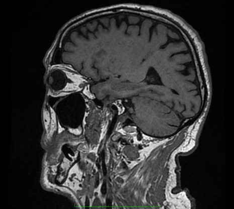 Магнитно-резонансно томографический снимок головы