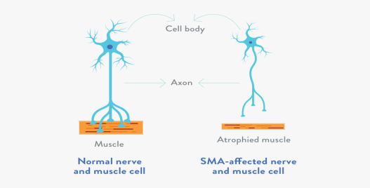 Патогенез спинальной мышечной атрофии: гибель нейронов из-за дефектного белка, который провоцирует развитие заболевания, приводит к неспособности двинаться, развиваться и даже дышать