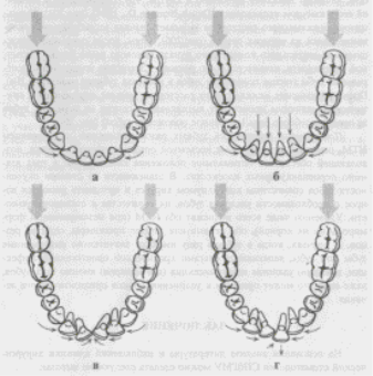 Схема формирования скученности в переднем отделе нижней челюсти при прорезывании третьих моляров