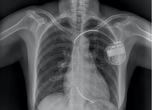 Рентгенограмма, на которой виден имплантированный кардиостимулятор